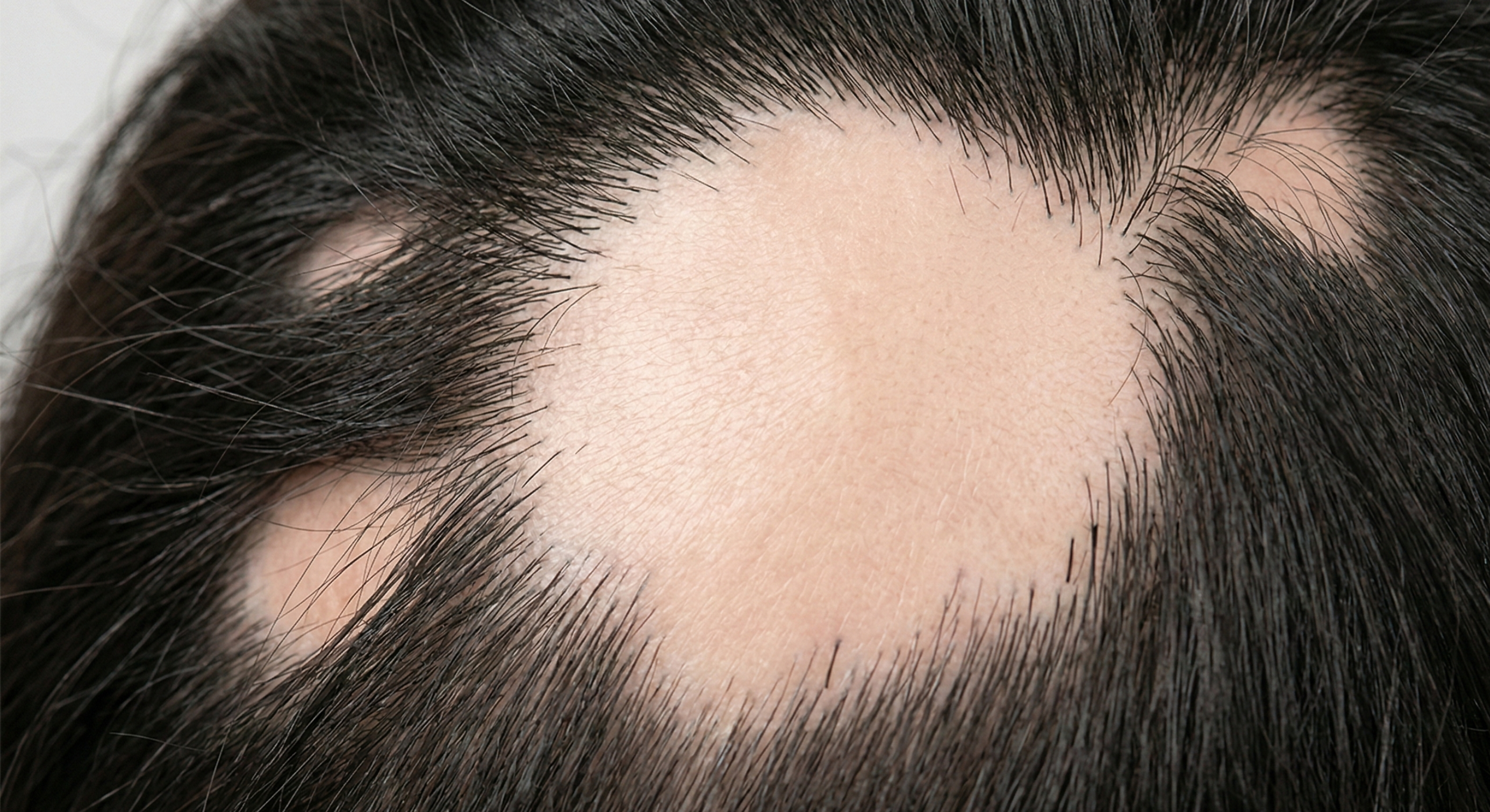 Alopecia